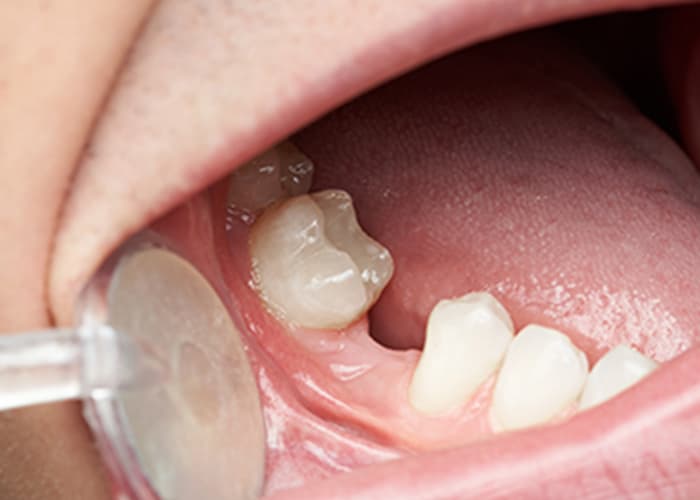 抜歯と補綴治療